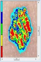 Skin Mole Analysis Cartaz