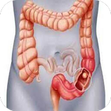 All about Colon Cancer