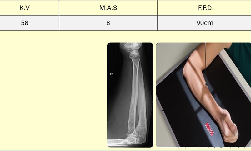 Xray extension