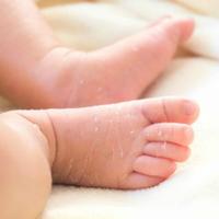 Peeling Skin in Babies Affiche