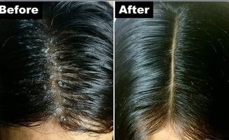 Get Rid of Dandruff Affiche