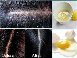 Get Rid of Dandruff اسکرین شاٹ 1