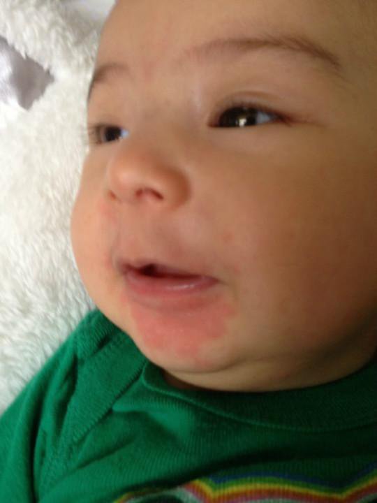 Drool Rash in Babies APK for Android Download