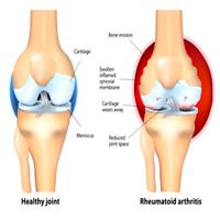 Bursitis ポスター