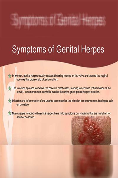 Genital herpes of 18 Facts
