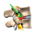 Herniated Disc Exercises