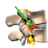 Herniated Disc Exercises icon
