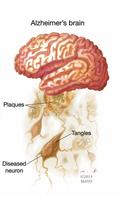 Alzheimer capture d'écran 1