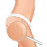 Stretch Marks Removal - Get Ri icono