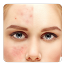 guide to Get rid of Acne APK