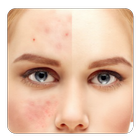 ikon guide to Get rid of Acne