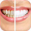 Home Remedies for Receding Gum.