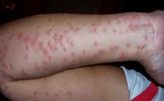Home Remedies for Insect Bites Screenshot 3