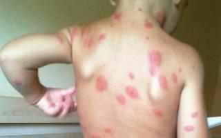 Home Remedies for Insect Bites Screenshot 1