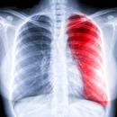 Chest X-ray Easy Guide APK