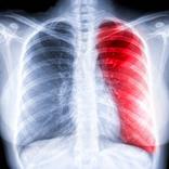 Chest X-ray Easy Guide