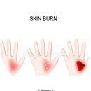 Skin Burns APK