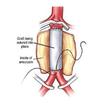 Sutures Guide of Blood Vessels (Pics Illustration)