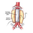 Sutures simgesi