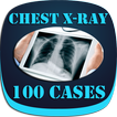 Interpret Chest X-Ray With 100 Cases