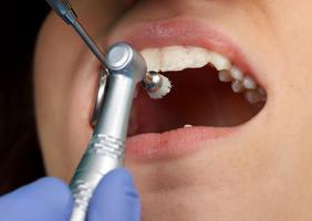 Cómo se Realiza una Profilaxis Dental Ekran Görüntüsü 2
