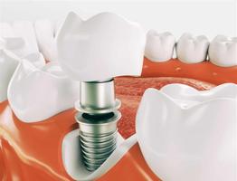 Cómo se hacen los Implantes Dentales Ekran Görüntüsü 2