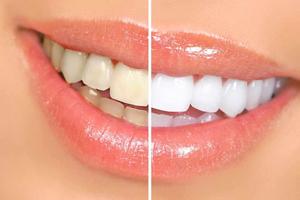 Cómo Quitar Manchas en los Dientes Ekran Görüntüsü 2