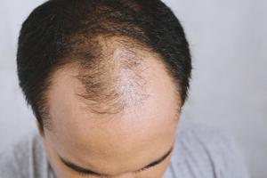 Cómo Prevenir la Calvicie Naturalmente Ekran Görüntüsü 3