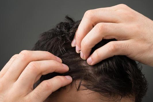Remedios Caseros Para La Caspa Del Cabello Graso For Android Apk