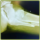 Fracture icône