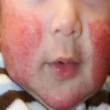 Pediatric Skin Disorders icône