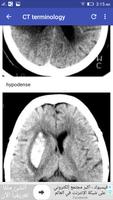 Stroke In CT স্ক্রিনশট 1
