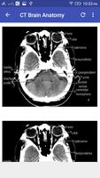 CT Brain 截圖 1