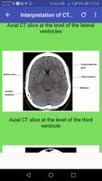 CT Brain Basic Interpretation capture d'écran 3