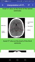 CT Brain Basic Interpretation ảnh chụp màn hình 3