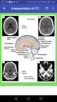 CT Brain Basic Interpretation capture d'écran 2