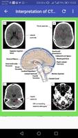 CT Brain Basic Interpretation ภาพหน้าจอ 2