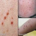 Skin Disorder