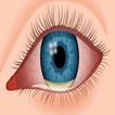 Common Eye Diseases