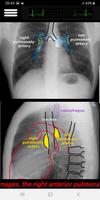 Easy Chest X-Ray screenshot 3