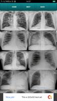 POCKET RADIOLOGIST CXR imagem de tela 1