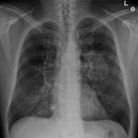 Lung Cancer capture d'écran 1