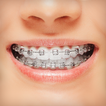 Braces - kawat gigi