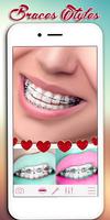 Braces Photo Editor Affiche