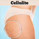 Cellulite Removal Workout
