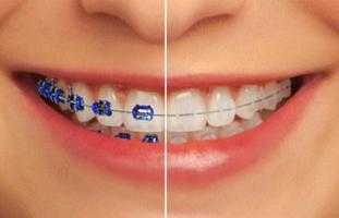 Dental Braces poster