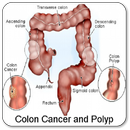 APK Colon Cancer