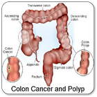 Colon Cancer icône