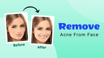 Remove Acne from Face ポスター