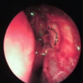 ENTSURGERY